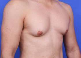 Gynecomastia Surgery Before & After Image