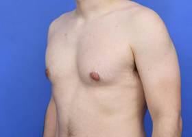 Gynecomastia Surgery Before & After Image