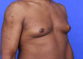 Gynecomastia Surgery Before & After Image