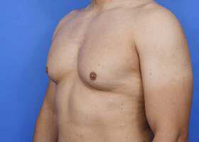 Gynecomastia Surgery Before & After Image