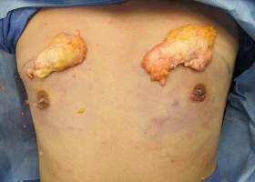 Gynecomastia Surgery Before & After Image