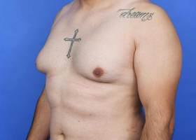 Gynecomastia Surgery Before & After Image