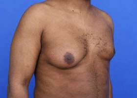 Gynecomastia Surgery Before & After Image