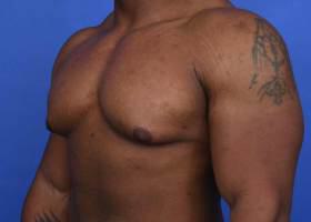 Gynecomastia Surgery Before & After Image