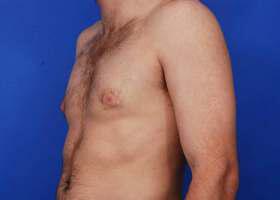 Gynecomastia Surgery Before & After Image