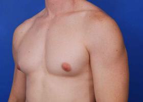 Gynecomastia Surgery Before & After Image