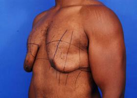 Gynecomastia Surgery Before & After Image