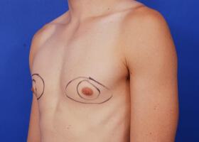 Gynecomastia Surgery Before & After Image
