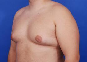 Gynecomastia Surgery Before & After Image