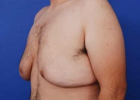 Gynecomastia Surgery Before & After Image
