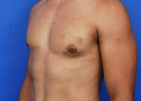 Gynecomastia Surgery Before & After Image