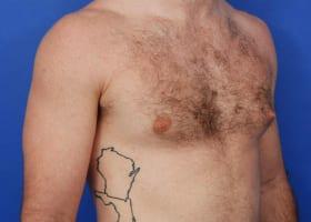 Gynecomastia Surgery Before & After Image