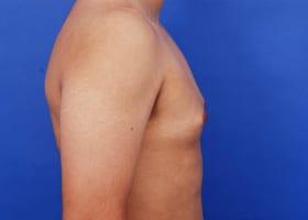 Gynecomastia Surgery Before & After Image