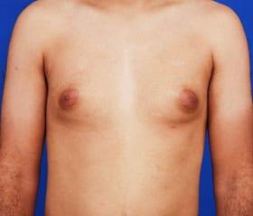 Gynecomastia Surgery Before & After Image