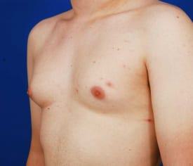 Gynecomastia Surgery Before & After Image