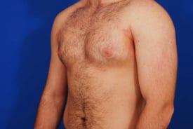 Gynecomastia Surgery Before & After Image