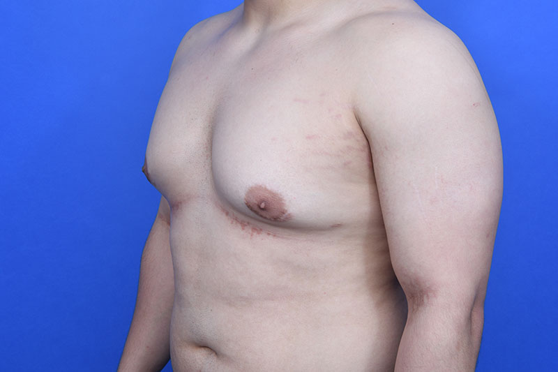 Gynecomastia Surgery Before & After Image