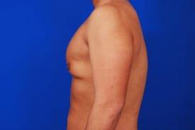 Gynecomastia Surgery Before & After Image