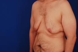 Gynecomastia Surgery Before & After Image