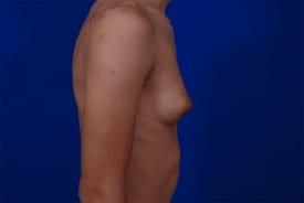 Gynecomastia Surgery Before & After Image