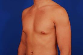 Gynecomastia Surgery Before & After Image