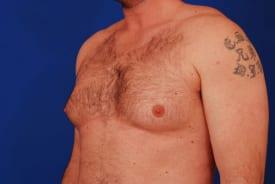 Gynecomastia Surgery Before & After Image