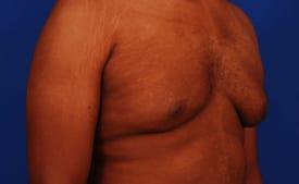Gynecomastia Surgery Before & After Image
