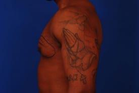 Gynecomastia Surgery Before & After Image