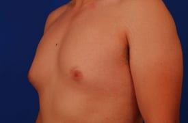 Gynecomastia Surgery Before & After Image