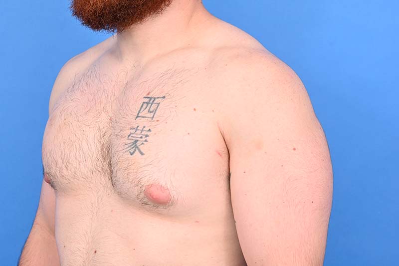 Gynecomastia Surgery Before & After Image