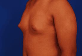 Gynecomastia Surgery Before & After Image