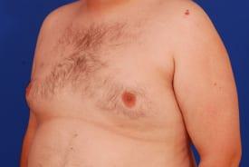 Gynecomastia Surgery Before & After Image