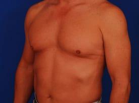 Gynecomastia Surgery Before & After Image