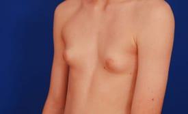 Gynecomastia Surgery Before & After Image
