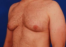 Gynecomastia Surgery Before & After Image