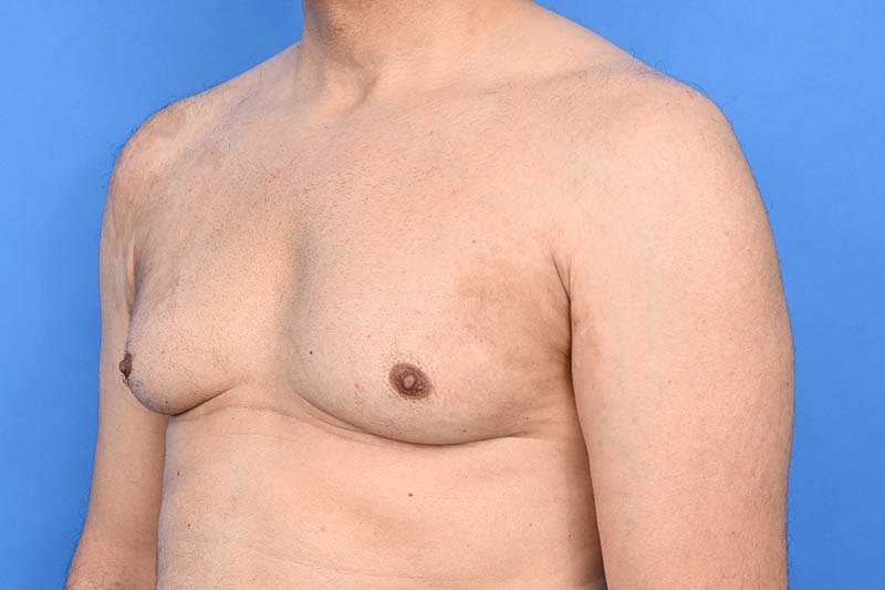 Gynecomastia Surgery Before & After Image