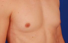 Gynecomastia Surgery Before & After Image