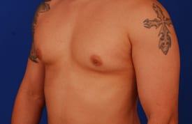 Gynecomastia Surgery Before & After Image