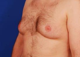 Gynecomastia Surgery Before & After Image