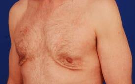 Gynecomastia Surgery Before & After Image