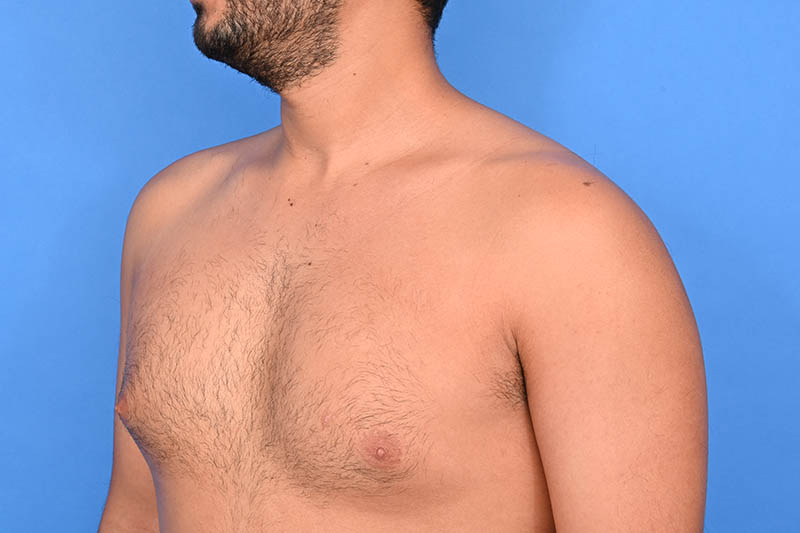 Gynecomastia Surgery Before & After Image
