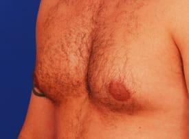Gynecomastia Surgery Before & After Image