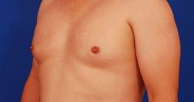 Gynecomastia Surgery Before & After Image