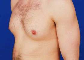Gynecomastia Surgery Before & After Image
