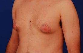 Gynecomastia Surgery Before & After Image