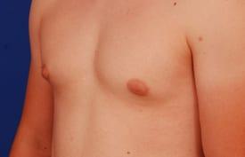 Gynecomastia Surgery Before & After Image