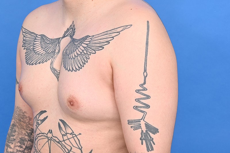 Gynecomastia Surgery Before & After Image