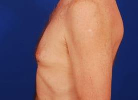 Gynecomastia Surgery Before & After Image