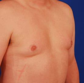Gynecomastia Surgery Before & After Image