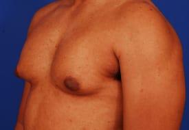 Gynecomastia Surgery Before & After Image